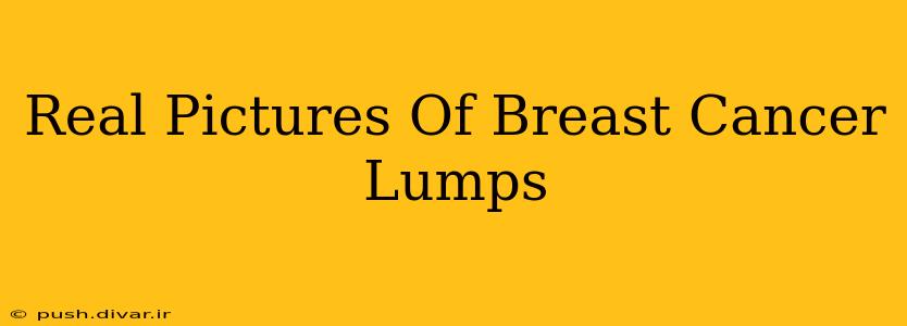 Real Pictures Of Breast Cancer Lumps